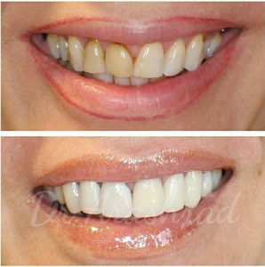 لمینت سرامیکی